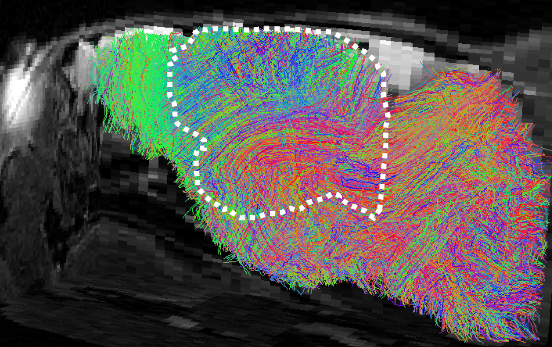 Map of estimated nerve-fiber pathways in the brain of a xenocortical mouse: the dashed white lines shows the xenocortical graft, 